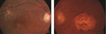 Figure 1. Dry AMD. A. Drusen. B. Geographic atrophy Photo courtesy Anat Loewenstein, MD