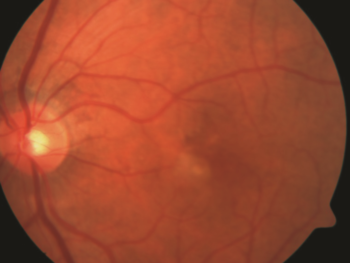 Figure 2. Wet AMD. Choroidal neovascularization. Photo courtesy Anat Loewenstein, MD