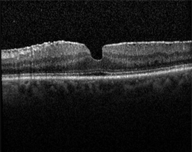 Figure 1. Epiretinal Membrane (OCT) John Pollack, MD, Rush University Medical Center. Retina Image Bank, 2012; Image 181. ©American Society of Retina Specialists