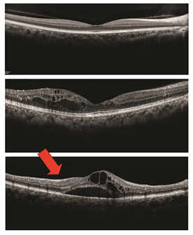 Figure 2. Optical Coherence Tomography and Macular Edema (Images courtesy of the ASRS Retina Image Bank, contributed by Dr. Suber Huang) OCT is a useful test to study macular edema (ME). • The top image is normal. Note the even layers and gently sloping dip of the macula called the fovea. This eye has excellent vision. • The middle OCT has ME, black-appearing cysts (arrows) which threaten the normal fovea. This eye also has good vision. • The bottom OCT shows ME involving the macula. Because ME involves the macular center (the fovea), vision is poor (large red arrow).