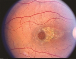 This image was originally published in the ASRS Retina Image Bank. Eric A. Postel, MD, Duke Eye Center. Traumatic Macular Hole. Retina Image Bank 2012; Image 2858. © the American Society of Retina Specialists.
