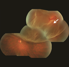 Superior macula-involving retinal detachment with a retinal tear identified with arrow.